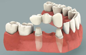 Dental Bridges The Woodlands Texas