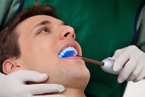 Tooth colored fillings the woodlands texas